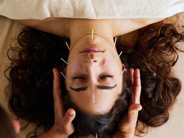 Can Acupuncture Improve Nervous System Regulation in Migraine&nbsp;Sufferers